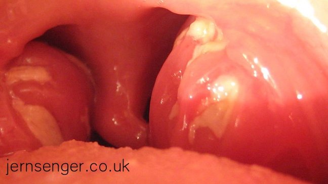 Sourthrout Explained: Causes, Symptoms and Natural Relief